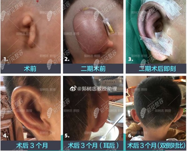 一,郭院全包法耳再造案例:小耳畸形矫正一年后图片二,郭树忠全包法耳