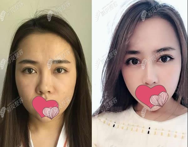 李茂群医生鼻子做的怎么样这里有他做鼻综合术前后照片哦