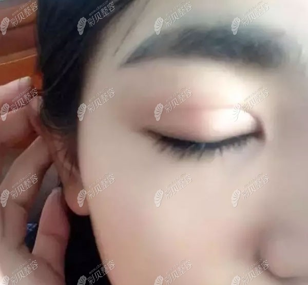 福州新世纪的全切双眼皮去脂去皮效果图看过的人都想做