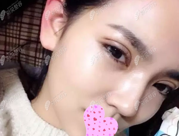 福州新世纪的全切双眼皮去脂去皮效果图,看过的人都想
