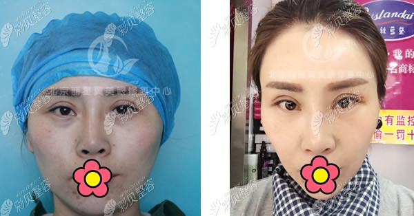 图中的小姐姐,眼睛已经修复过四次了,但依然有多层眼皮,左眼睁不开的