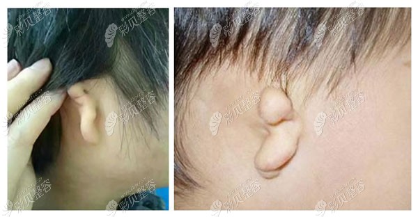 新生宝宝20天外耳廓有点畸形发育不全现在能矫正或修复吗