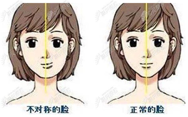 我18岁脸颊两边的骨头不对称,特别是下颌骨一边突出一边不突出,成了