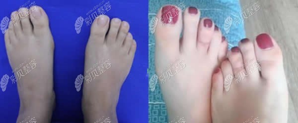 北京正规治疗大脚骨的医院中煤医和圣嘉新哪个更靠谱些
