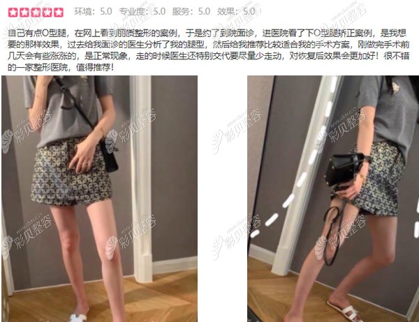 上海丽质卢九宁医生直腿成形术费用多少钱?包含哪些项目