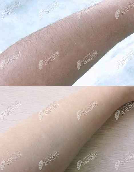 乌鲁木齐华美整形脱毛前后对比图