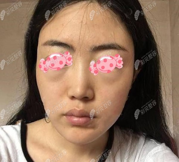28岁的我在郑州广运整形做面部小切口提升1-7天恢复图片对比