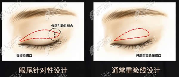 陈杨双眼皮眼尾设计与普通双眼皮区别