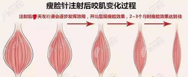 在武汉打进口瘦脸针改善咬肌一针需要多少钱