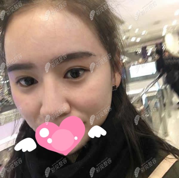 郑州美莱周蔚医生做的肋骨鼻综合修复手术居然7天能拆线