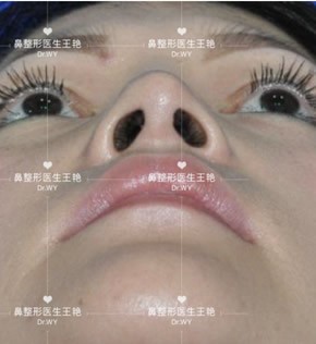 上海王艳医生肋骨鼻修复效果测评：取出肋软骨还能2次使用