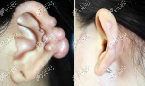 上海江城皮肤病医院耳洞疤痕疙瘩治疗术前后对比