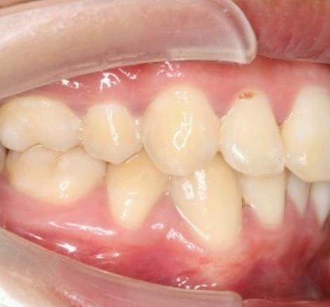 成人戴隐适美牙套矫正龅牙前后对比照，20岁矫正牙齿并不晚