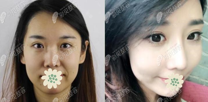 西宁时光整形鼻综合术前后对比照片