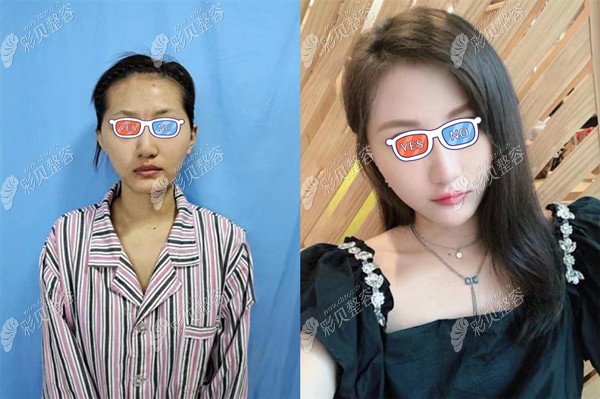 合肥福华赵章杰自体脂肪填充面部对比效果图