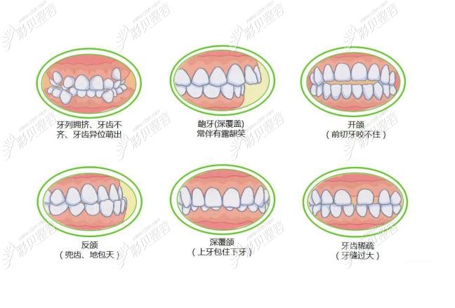 牙齿咬合错误的症状表现