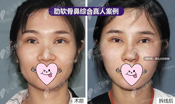 太原欧美莲肋软骨隆鼻例子效果对比图