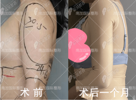 果冻脂肪隆胸对比照参考