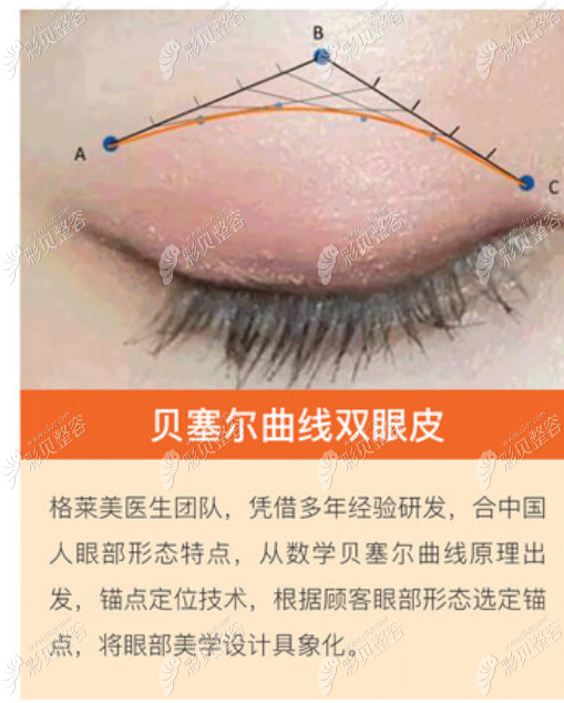 杭州格莱美张霞飞医生做双眼皮的优势睑缘切开隐藏痕迹