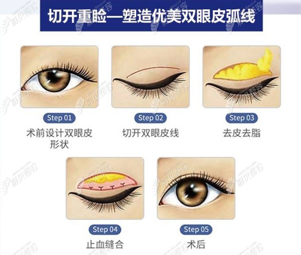 切开双眼皮过程和步骤