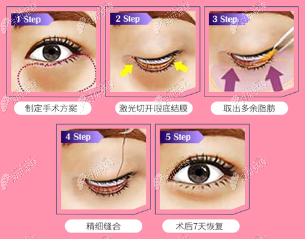 南京华美裴旭芳割眼袋怎么样,找她做内切去眼袋价格贵嘛