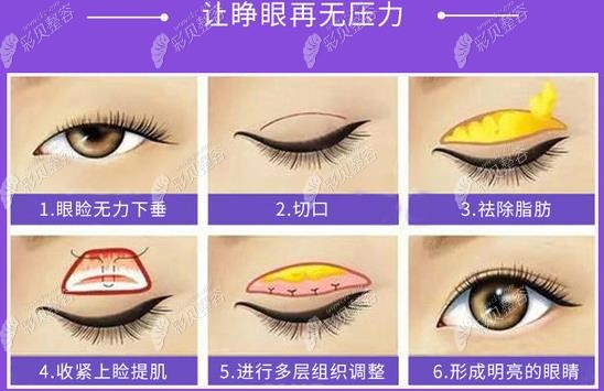 割双眼皮做和不做提肌前后对比图,区别大不大能直观看出!