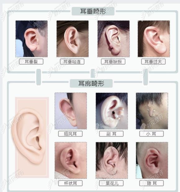 国内做耳朵畸形矫正好的医院排名,附北京,郑州耳整形价格