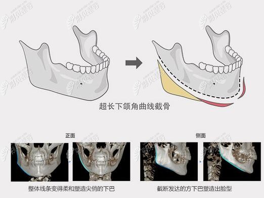 上海李志海做下颌角截骨手术怎么样说下他磨骨是什么风格