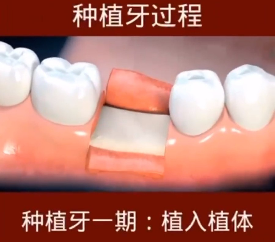 微创种牙和传统种植牙哪个好?微创种植牙的利弊有这些