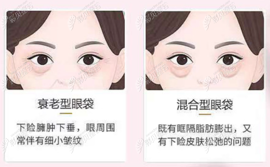 宁波薇琳哪个医生做眼睛好啊,找他做个眼袋手术得多少