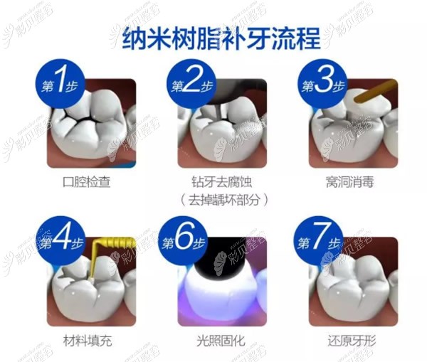 纳米树脂补牙流程和步骤