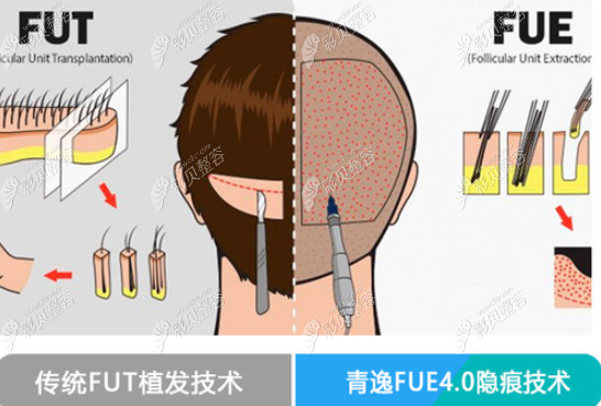 青逸FUE4.0植发和传统技术对比
