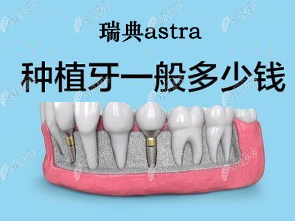 的价格在瑞典牙齿种植体品牌排行榜中算贵吗 瑞典阿斯特拉astra种植体