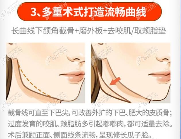 北京南加做下颌角磨骨怎么样马福顺磨骨实例多技术靠谱