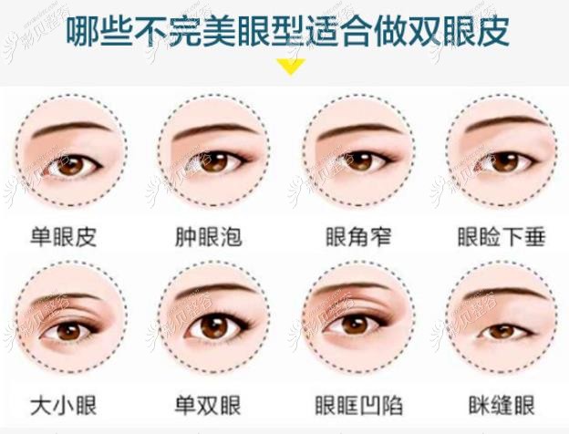 哪些眼睛适合做双眼皮