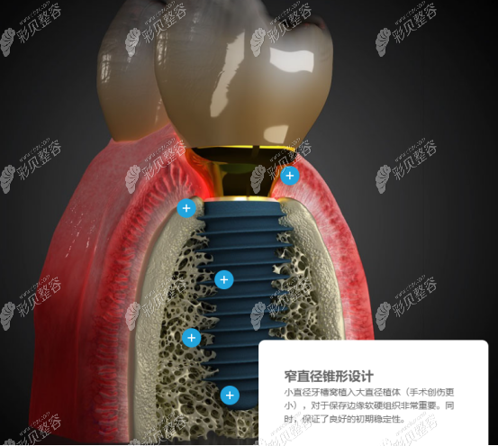 韩国美格真种植体多少钱结合优点以及产品型号为你解析