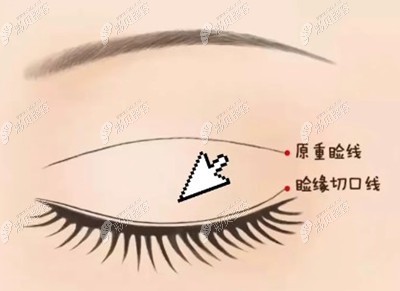 深圳艺星牛克辉医生做睑缘口式双眼皮价格能修复埋线吗