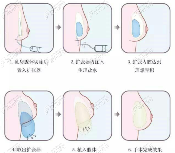 假体乳房再造术