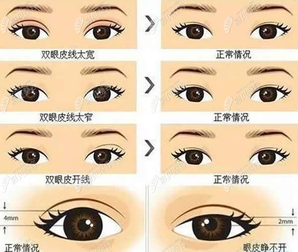 您现在的位置:>首页>整形资讯>义乌连天美整形王馨婉医生割双眼皮好吗
