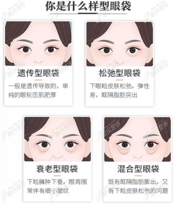 眼袋类型图