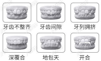 牙列不齐等示意图