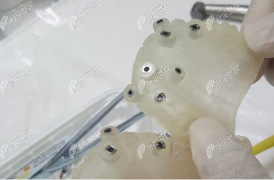 全口种植牙过程分为几个步骤种牙的过程是不是很遭罪