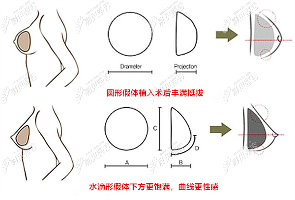 如果是乳房轻微下垂的姐妹,水滴形假体的下方更饱满,和真实的胸一样有