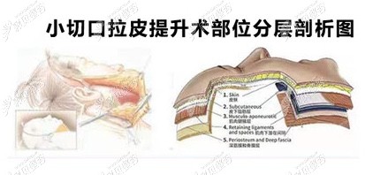 微创小切口拉皮手术比较新的方式有什么手术费一般多少钱