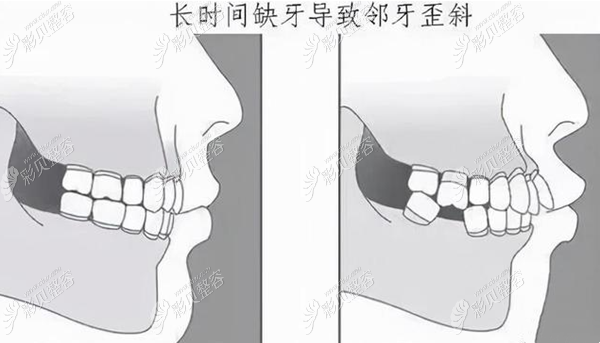 牙缺失多年导致旁边牙齿倾斜的补救方法是种植还是矫正呢