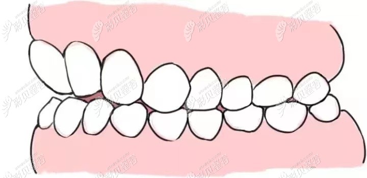 看下牙齿向内倾斜造成的原因来分析牙齿内扣有必要矫正吗