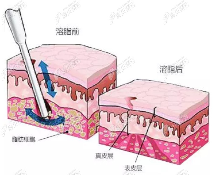 从面部吸脂和面部光纤溶脂的优缺点和区别来看它们哪个好