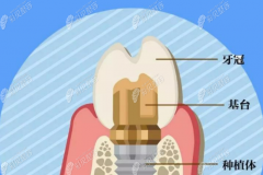 辟谣牙医说千万不要种植牙，他们没说的种植牙危害可忽略