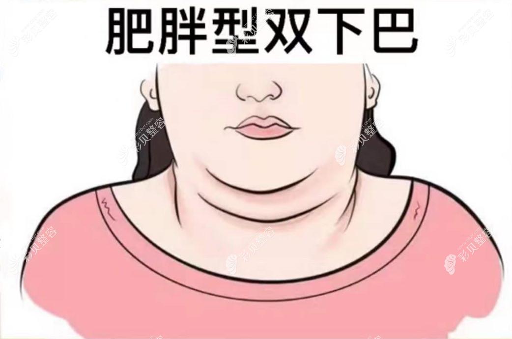 快速消除双下巴的4个有效方法抽脂溶脂激光紧肤手术提拉