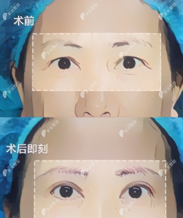 乌鲁木齐做提眉手术前后对比
